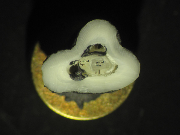 Image obtained with SEM with an Si(Li) energy-dispersive detector. A pulp stone with two layers separated