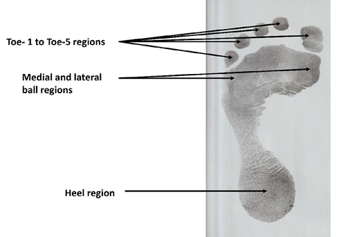 This is an illustration of a human footprint showing the anatomical regions used in sex estimation from footprint ridge density.