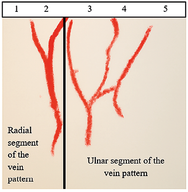 This figure shows the original imprint of the dorsal hand vein pattern on the left hand. It shows a radial segment of the vein pattern and an ulnar segment of the vein pattern. Scores 1 to 5 indicate numbers of the interphalangeal spaces.