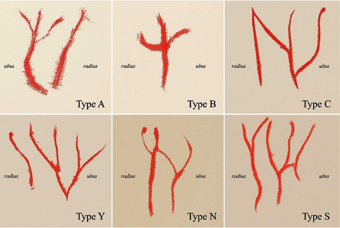 This figure shows the basic types of dorsal hand vein patterns as per Suchý (1951b) classification. Type A to C is shown as branched variants. Type Y is shown as double-branched. Type N is known as simple, wheareas Type S is known as composite pattern with radial contribution).