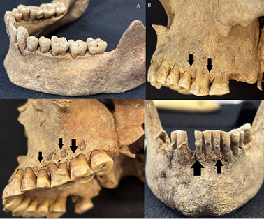 This is a composite figure showing four different stages of periodontal disease progression observed on the jaws of the individuals analysed in this study. The images show progression from stages: healthy, early stage, moderate stage, advanced stage.