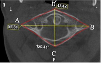 Image of the atlas bone with landmarks marked on the image indicating parameters used for measurements in this study.