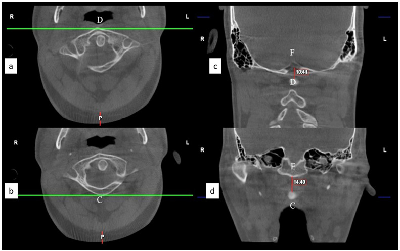 Composite image of the atlas and skull base with representative landmarks used for measurements in this study. 